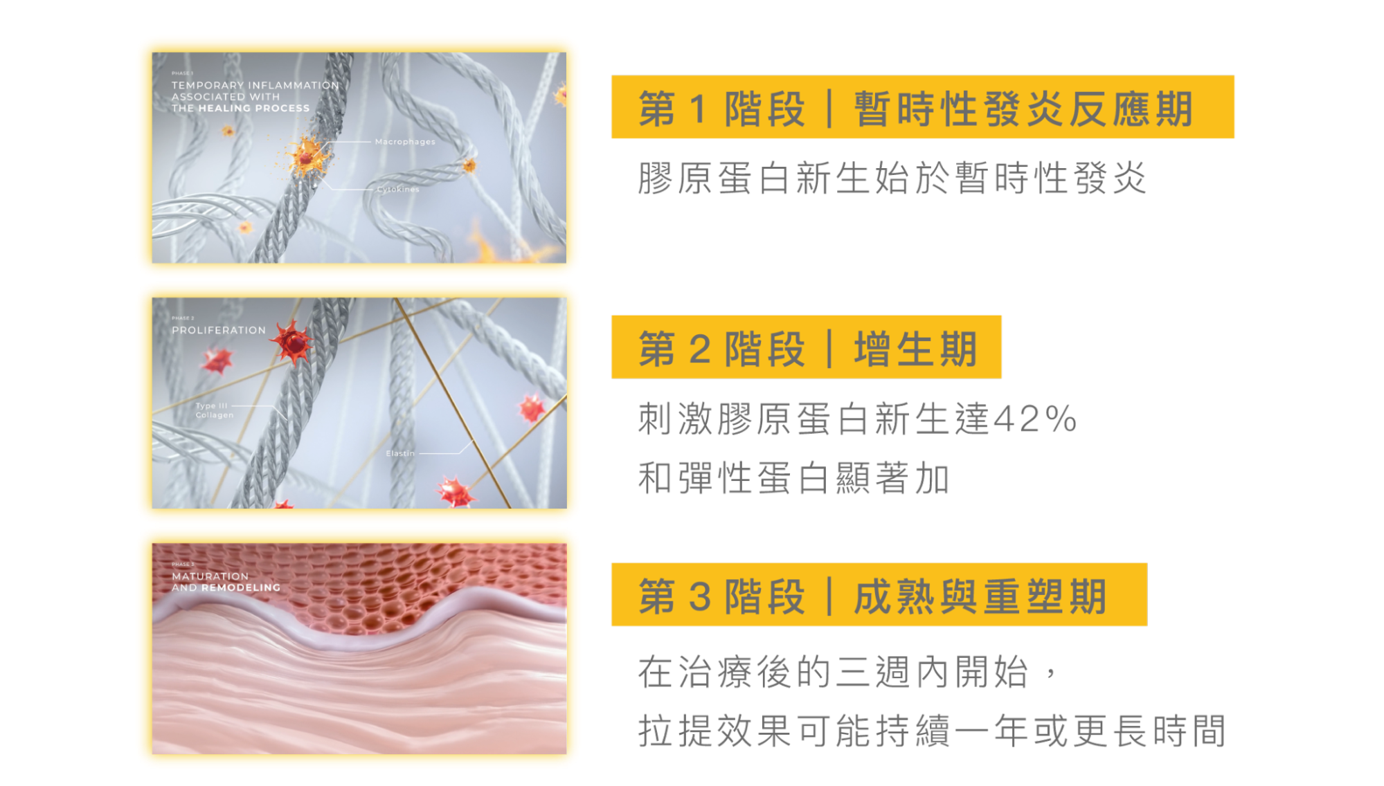 美國音波第二代治療階段