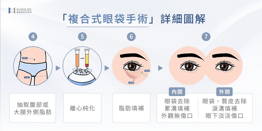 複合式眼袋手術圖解