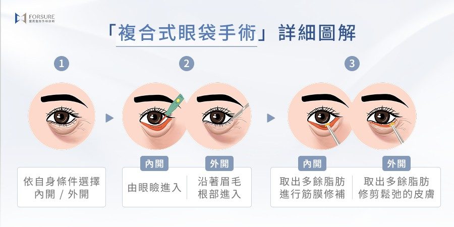 4 大嘴邊肉醫美方案