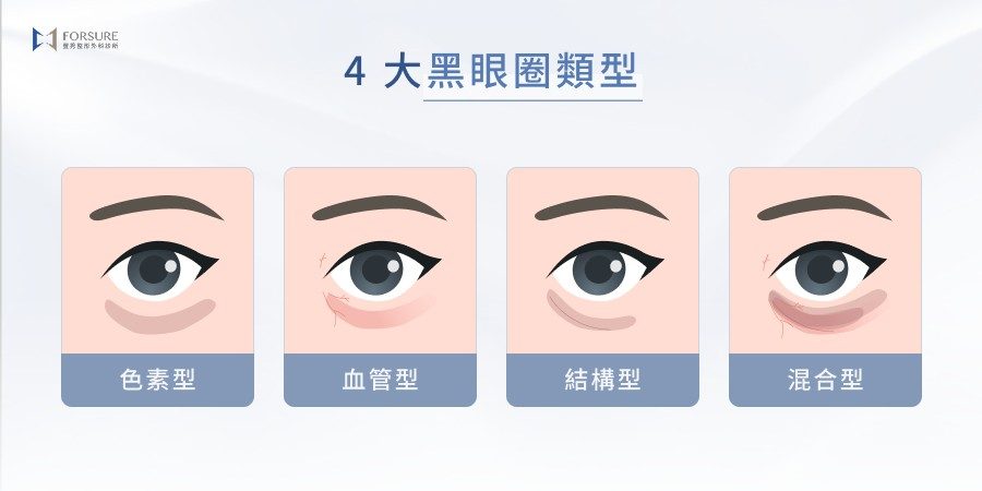 4 大黑眼圈類型